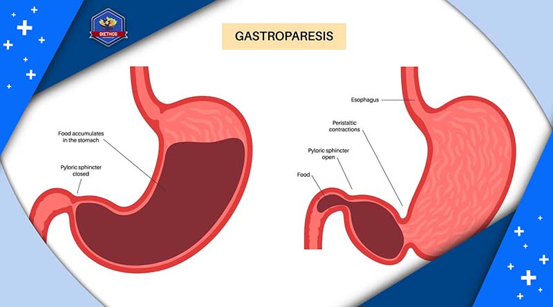 What Is Gastroparesis